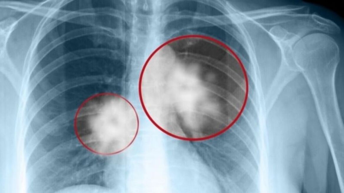 Επαναστατική τεχνική για τη διάγνωση του καρκίνου στον πνεύμονα χωρίς χειρουργείο